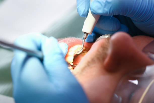 Best Emergency Tooth Extraction in Bonduel, WI